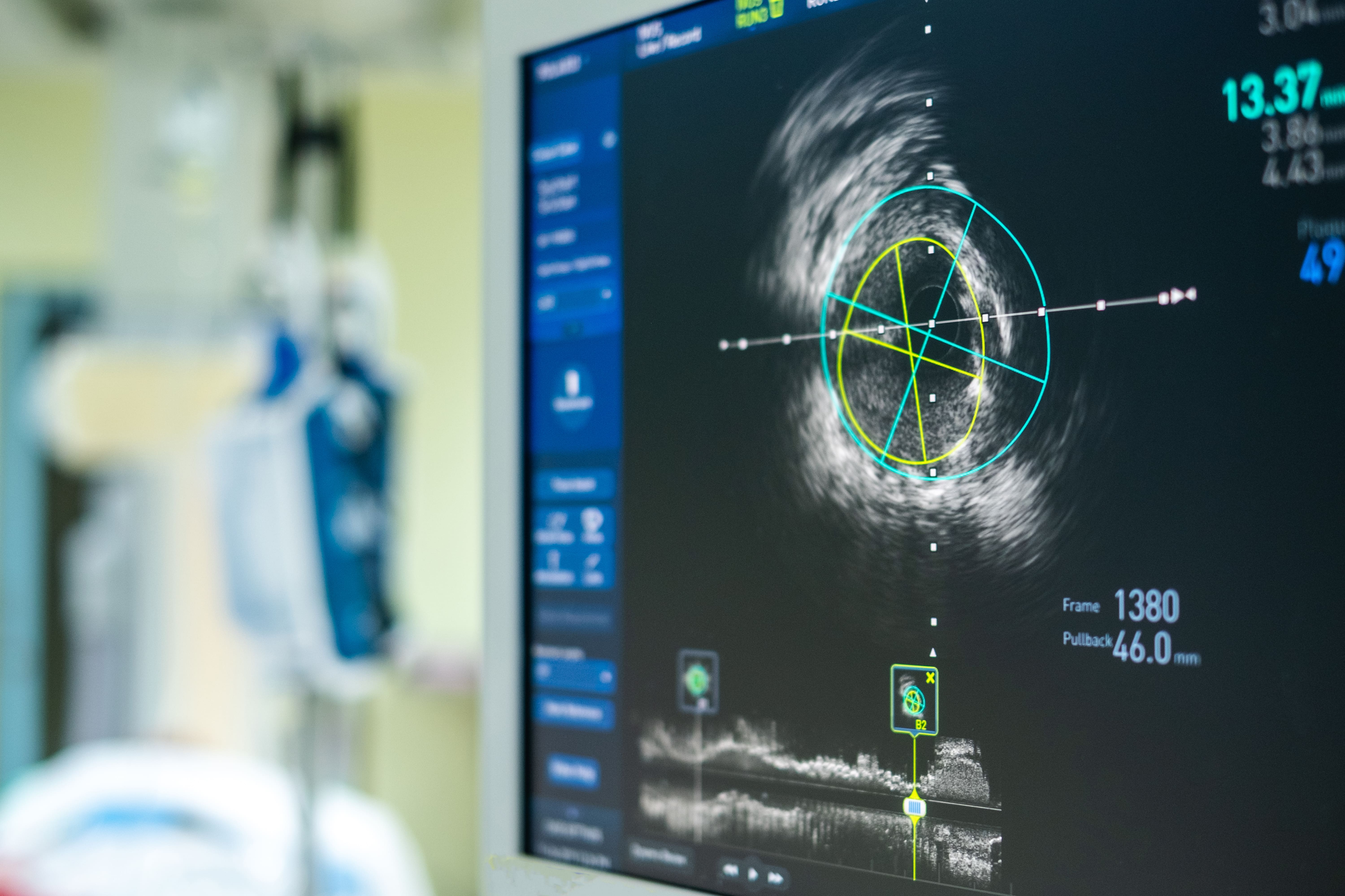 Intravascular ultrasound imaging (IVUS) at cardiac catheterizati